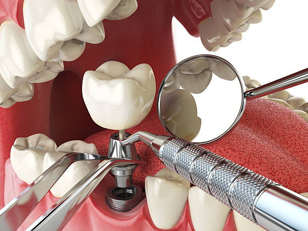 Best Emergency Tooth Extraction in Brookville, PA